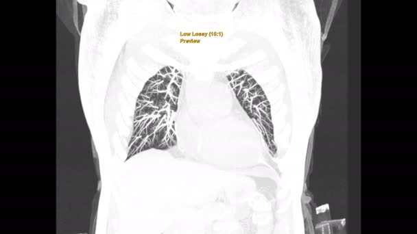 Scan Thoracique Poitrine Humaine Technique Filtre Pulmonaire Coronal Mip View — Video