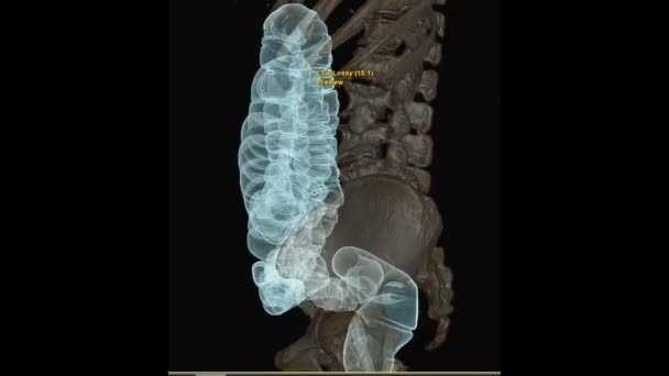 Ct大腸がんスクリーニングのための解剖学的結腸を示す透明な骨を持つ結腸3Dレンダリング画像のCt大腸がんまたはCtスキャン チェックアップスクリーニング Colon Cancer — ストック動画