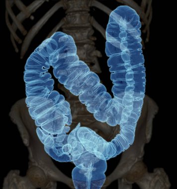 CT colonography  or CT Scan of Colon 3D Rendering image AP view  showing colon for screening colorectal cancer. Check up Screening Colon Cancer clipart
