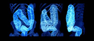 Collection of CT colonography  or CT Scan of Colon 3D Rendering image  showing colon for screening colorectal cancer. Check up Screening Colon Cancer clipart