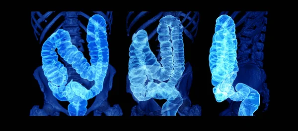大腸がんスクリーニングのための結腸を示すCt大腸3Dレンダリング画像の大腸がんまたはCtスキャンのコレクション チェックアップスクリーニング Colon Cancer — ストック写真