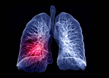 CT Göğüs veya Lung 3D görüntüleme seçici odak TB, tüberküloz ve covid-19 teşhisi için ekranda geri dönün .