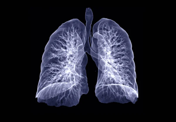 Klatki Piersiowej Lub Płuc Obraz Renderowania Obrócić Ekranie Diagnozy Gruźlicy — Zdjęcie stockowe