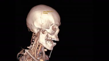 CTA Beyin ya da beynin hesaplanmış tomografi anjiyografisi 3D görüntüleme ekranda kafatası dönen ortak şah damarını gösteriyor.