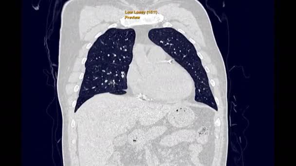 CT Chest ou HRCT Coronal View avec haute résolution Technique de filtration pulmonaire pour le diagnostic de la tuberculose, de la tuberculose et de la covide-19 .
