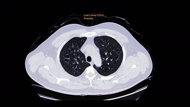 CT Poitrine ou HRCT Vue Axiale avec haute résolution Technique de filtration pulmonaire pour le diagnostic TB, tuberculose et covide-19 .