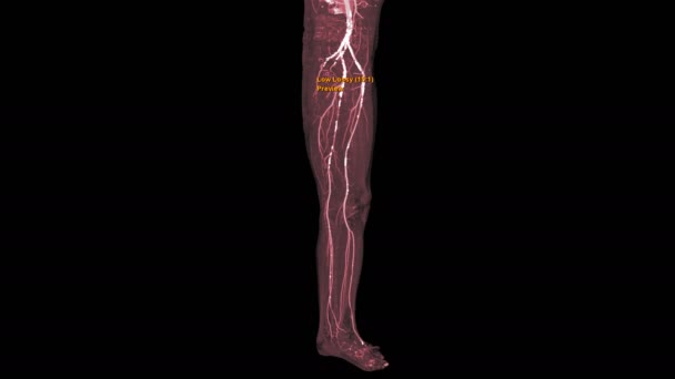 Cta股动脉走行3D Mip视图转回黑色背景 — 图库视频影像