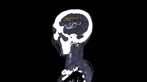 Cta Angiographie Cérébrale Tomodensitométrie Cerveau Vue Médiane Sagittale Montrant Artère — Video