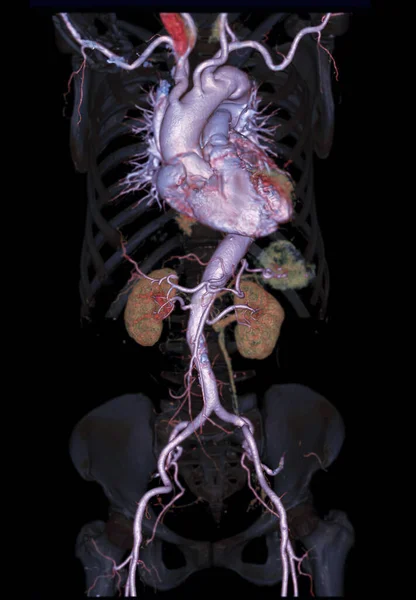 透明骨格上のCta腹部大動脈3Dレンダリング画像 — ストック写真
