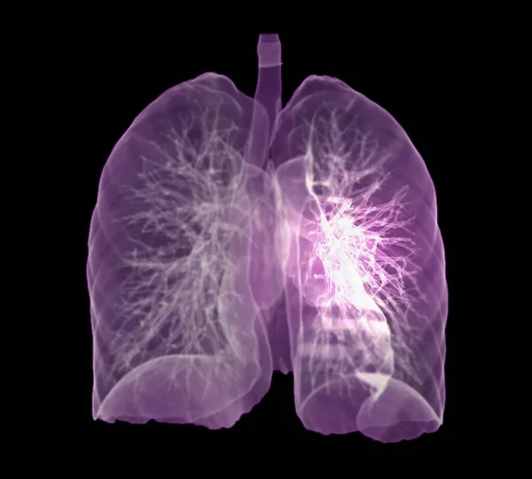 Brust Oder Lunge Rendering Bild Zur Diagnose Tuberkulose Und Covid — Stockfoto