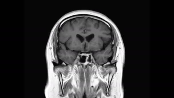 Mri Mózg Koronowany Widok Gradiente Wykrywania Choroby Udaru Mózgu Covid — Wideo stockowe