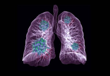 CT Chest or Lung 3D rendering image with virus 3D rendering on black background for diagnosis TB,tuberculosis and covid-19 . clipart