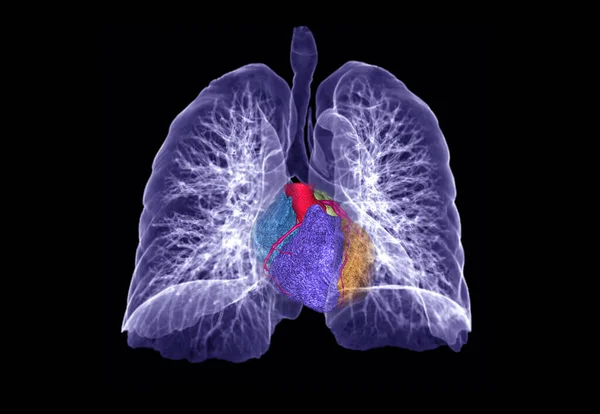 Chest Lung Immagine Rendering Con Cuore Diagnosi Tubercolosi Tubercolosi Covid — Foto Stock