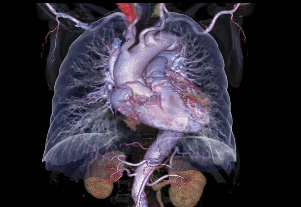 Cta Chest Lung Rendering Image Showing Heart Lung Amd Bone — Stock Photo, Image