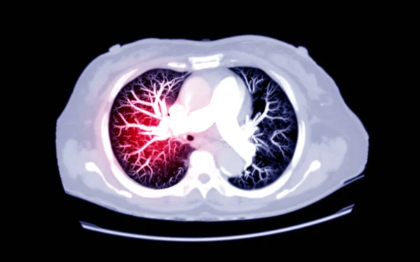 Foco Seletivo Peito Axial Mip Vista Para Diagnóstico Embolia Pulmonar — Fotografia de Stock