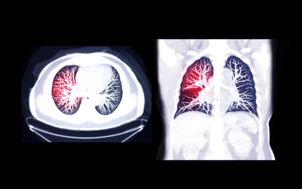 Selective Focus Chest Axial Coronal Mip View Diagnostic Pulmonary Embolism — Stock Photo, Image