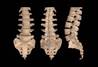 CT Lumbar veya L-S omurga 3D görüntüleme önü, arkası ve Lateral görünümü, L2 'de sıkıştırma çatlaklarını gösteriyor. 3B illüstrasyon.
