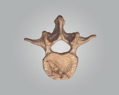 CT Lumbar ya da L-S omurga 3D görüntüleme gri arkaplan üst görünümü, L2, 3D resimleme sıkıştırma kırıkları gösterir. kırpma yolu.