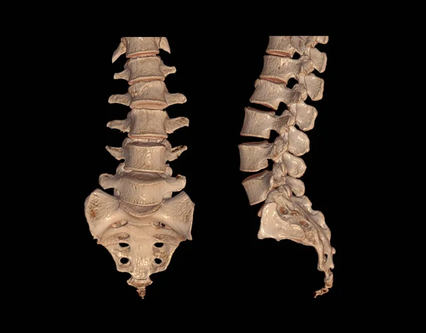 Ct腰椎或L S脊柱三维图像Ap和侧视显示L2处压迫性骨折的采集 3D插图 — 图库照片