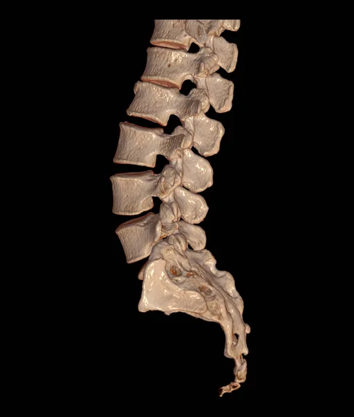 Lumbar Spine Rendering Image Vista Lateral Que Muestra Fracturas Por —  Fotos de Stock
