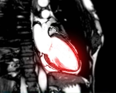 MRI heart or Cardiac MRI ( magnetic resonance imaging ) of heart  vertical long axis view showing left atrium or LA  for diagnosis heart disease. clipart