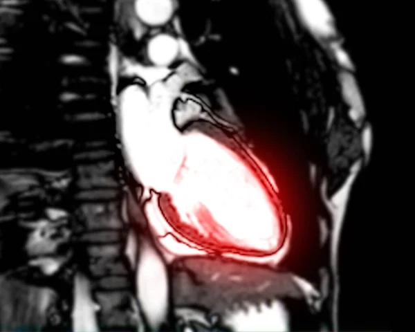 Мрт Сердца Сердца Мрт Магнитно Резонансная Томография Сердца Вертикальной Длинной — стоковое фото