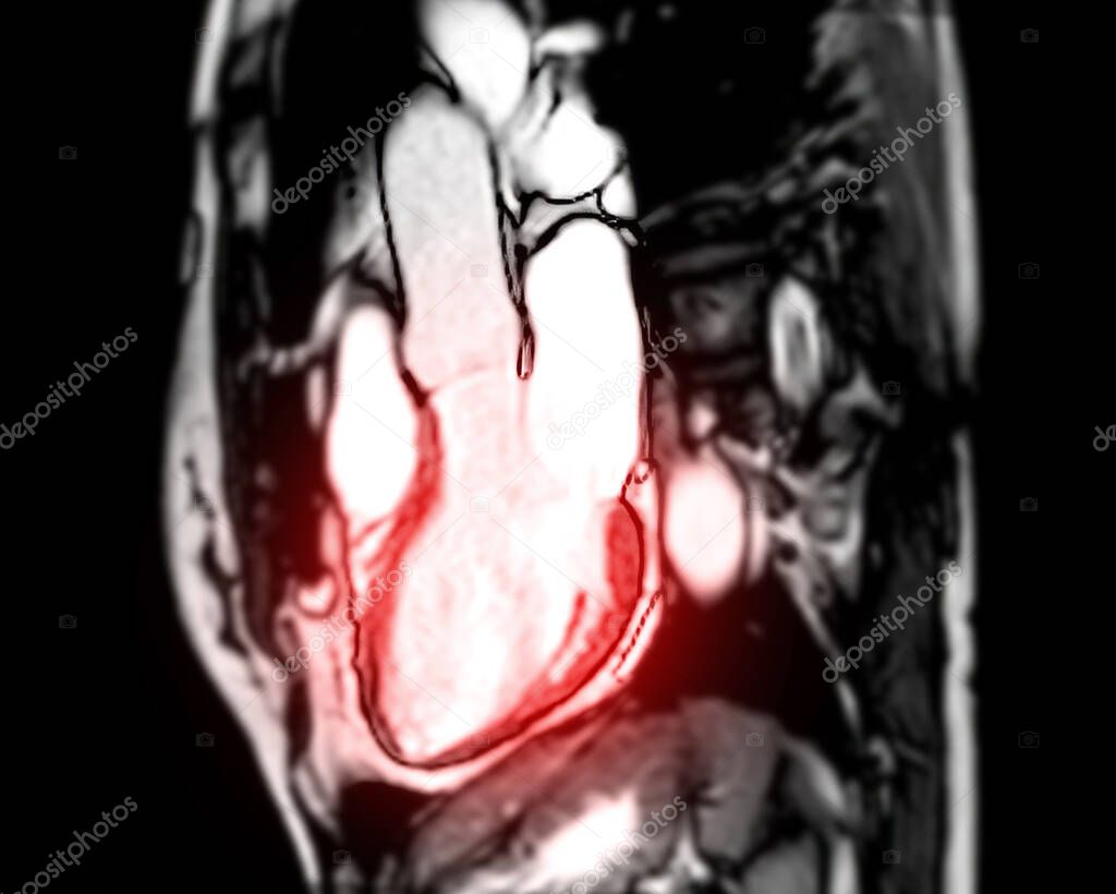 MRI heart or Cardiac MRI ( magnetic resonance imaging ) of heart LVOT for diagnosis heart disease.