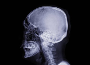  İnsan kafatasının kafatası x-ray görüntüsü Siyah Arkaplanda izole edilmiş.