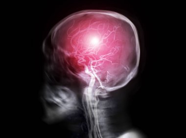 Kafatası x-ray görüntüsünün seçici odak noktası insan kafatası yanal görünüm füzyonu MRA beyin resmi ile .