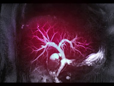 Manyetik rezonans cholangiopancreatography veya MRCP 3D MIP resmi safra ve pankreas kanallarını görselleştirmeyi gösteriyor. .