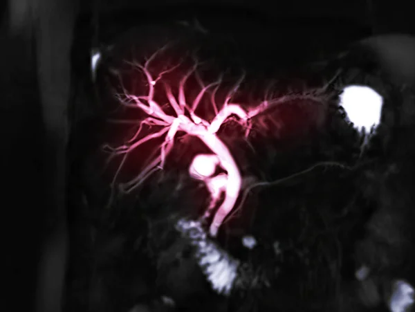 Rezonans Magnetyczny Cholangiopankreatografia Lub Mrcp Mip Obraz Przedstawiający Wizualizacji Dróg — Zdjęcie stockowe