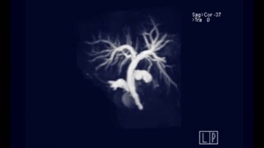 MRCP ya da Manyetik rezonans kolanjiyoplazma 3D MIP ekranda dönüp safra ve pankreas kanallarını görselleştirin .