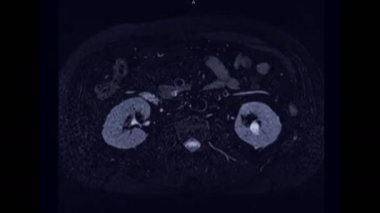MRCP ya da Manyetik rezonans kolanjiyoplaatografi eksen görüntüsü safra ve pankreas kanallarını görselleştirmeyi gösteriyor .
