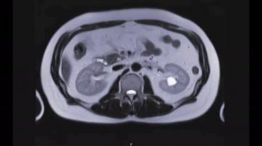 MRCP ya da Manyetik rezonans kolanjiyoplaatografi eksen görüntüsü safra ve pankreas kanallarını görselleştirmeyi gösteriyor .