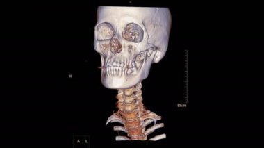 Boyun veya boyun omuru tomografisi. Hasta travma vakasının 3 boyutlu görüntüsü. Rahim kemiği kırığı teşhisi için döndür..