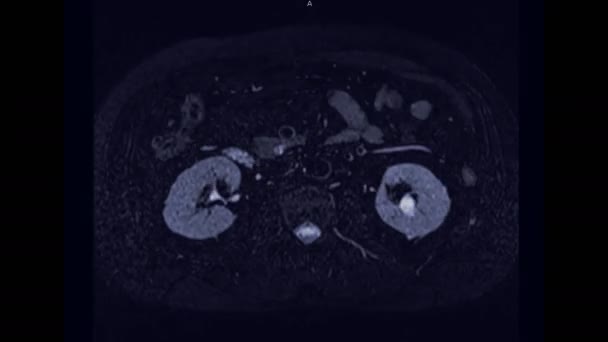 Mrcp Lub Rezonans Magnetyczny Cholangiopankreatografia Widok Osiowy Pokazujący Wizualizację Dróg — Wideo stockowe