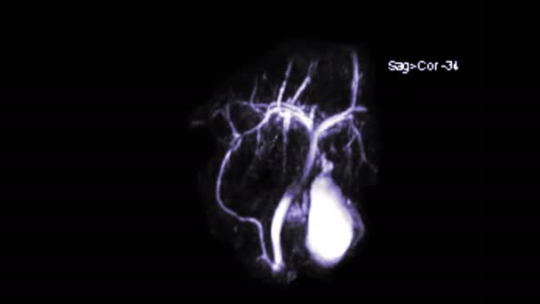 Mrcp Cholangiopancréatographie Par Résonance Magnétique Vue Mip Montrant Visualiser Les — Video