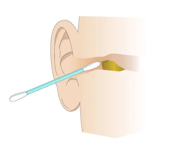 Illustration Des Gehörgangs Der Mit Einem Wattestäbchen Gereinigt Wird Werkzeug — Stockvektor