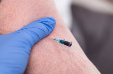 Damar yerleştirilen kateter