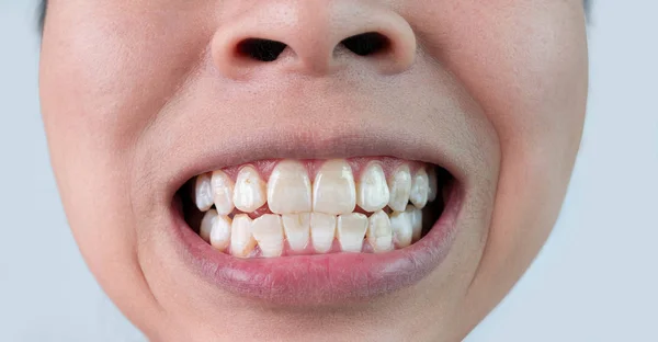 Primer Plano Los Dientes Una Mujer Sonriente Revelando Manchas Blancas — Foto de Stock