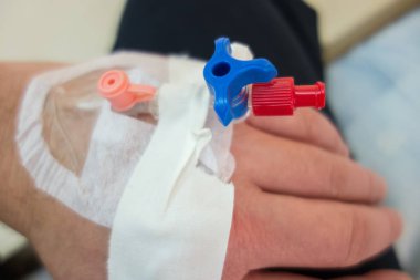 Elinde periferik Venöz kateter (venflon)