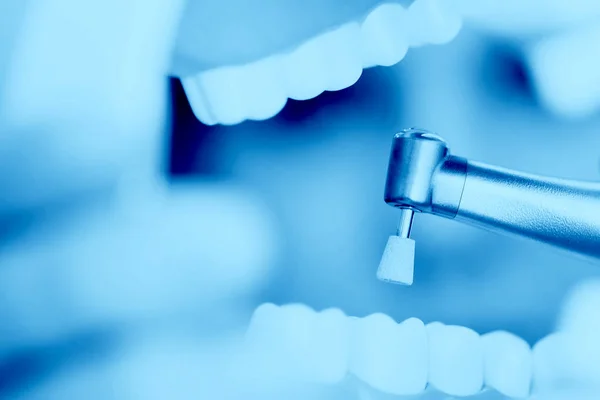 Una recepción en el consultorio del dentista, limpiando el esmalte de los dientes —  Fotos de Stock