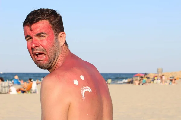 Homem Ficando Queimado Sol Praia — Fotografia de Stock