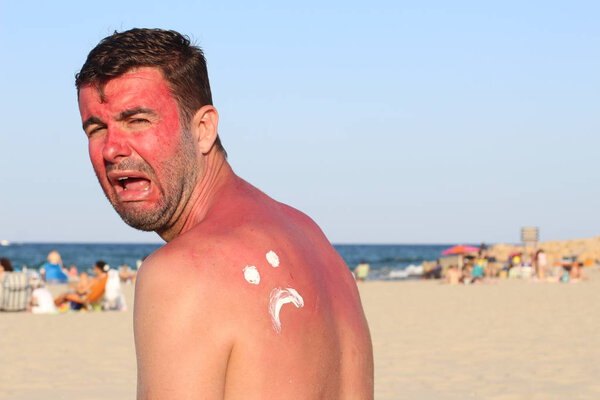 Man getting sunburned at beach