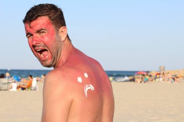 Man getting sunburned at beach clipart