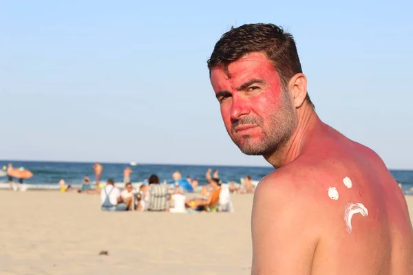 Hombre Recibiendo Sol Quemado Playa — Foto de Stock