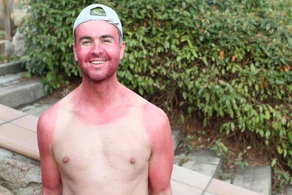 Sunburned young man with extreme tan lines
