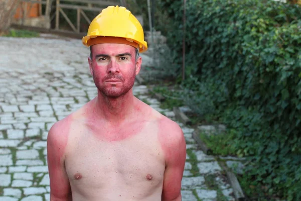 Ηλιακό Κάψιμο Νεαρός Άνδρας Ακραίες Γραμμές Μαυρίσματος — Φωτογραφία Αρχείου