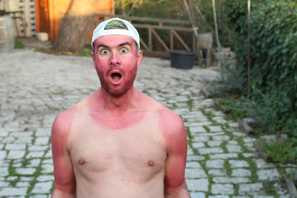 Sonnengebrannter Junger Mann Mit Extremen Bräunungslinien — Stockfoto