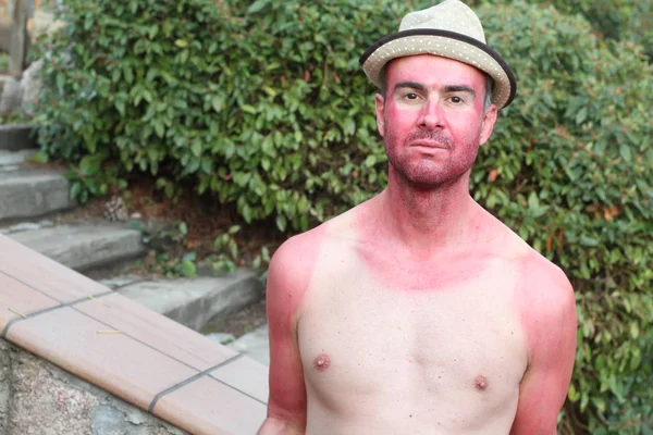 Sunburned young man with extreme tan lines